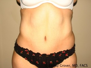 Tummy Tuck Before and After | Grover Aesthetics