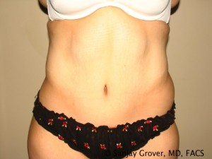 Tummy Tuck Before and After | Sanjay Grover MD FACS