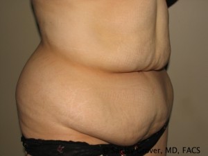 Tummy Tuck Before and After 77 | Grover Aesthetics