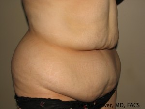 Tummy Tuck Before and After 77 | Sanjay Grover MD FACS