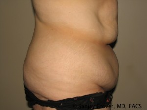 Tummy Tuck Before and After 77 | Sanjay Grover MD FACS