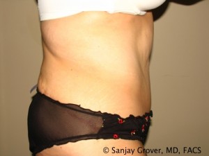 Tummy Tuck Before and After 77 | Sanjay Grover MD FACS