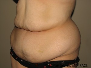 Tummy Tuck Before and After 77 | Sanjay Grover MD FACS