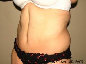 Tummy Tuck Before and After 77 | Sanjay Grover MD FACS