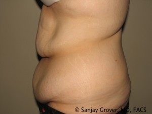 Tummy Tuck Before and After 77 | Grover Aesthetics