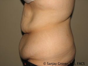 Tummy Tuck Before and After 77 | Sanjay Grover MD FACS