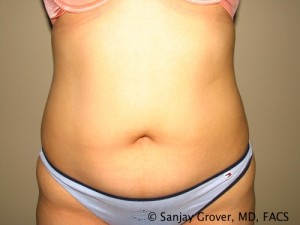 Tummy Tuck Before and After 97 | Sanjay Grover MD FACS