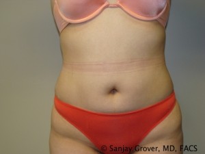 Tummy Tuck Before and After | Grover Aesthetics