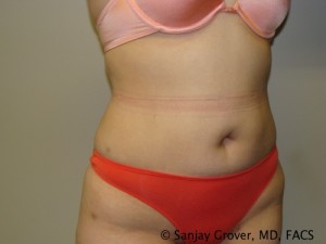 Tummy Tuck Before and After 78 | Sanjay Grover MD FACS