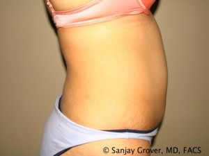 Tummy Tuck Before and After 78 | Sanjay Grover MD FACS