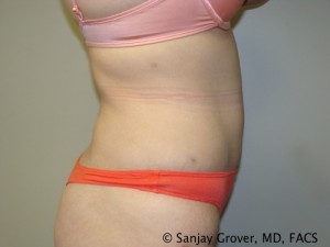 Tummy Tuck Before and After 78 | Grover Aesthetics