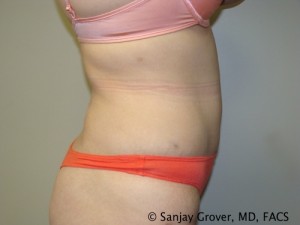 Tummy Tuck Before and After 78 | Sanjay Grover MD FACS