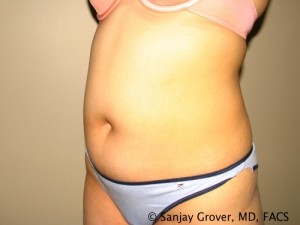 Tummy Tuck Before and After 78 | Sanjay Grover MD FACS