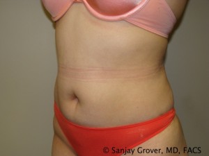 Tummy Tuck Before and After 78 | Sanjay Grover MD FACS