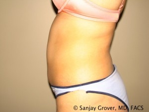 Tummy Tuck Before and After 78 | Sanjay Grover MD FACS