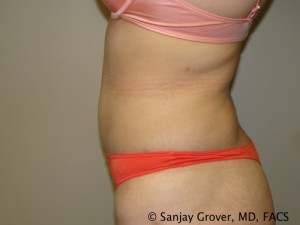 Tummy Tuck Before and After 78 | Sanjay Grover MD FACS