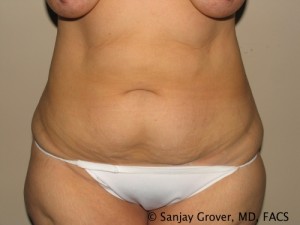 Tummy Tuck Before and After | Grover Aesthetics