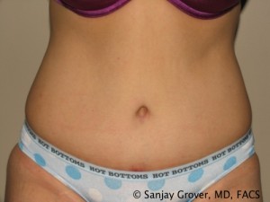 Tummy Tuck Before and After | Grover Aesthetics