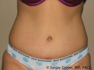 Tummy Tuck Before and After | Sanjay Grover MD FACS