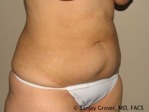 Tummy Tuck Before and After 79 | Sanjay Grover MD FACS