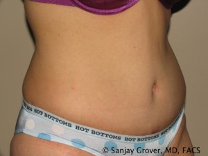 Tummy Tuck Before and After 79 | Sanjay Grover MD FACS