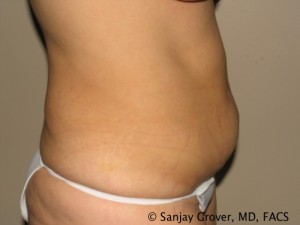 Tummy Tuck Before and After 79 | Sanjay Grover MD FACS