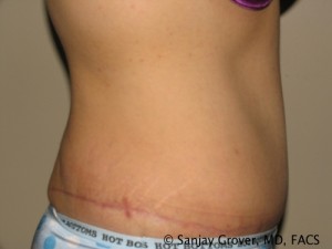 Tummy Tuck Before and After 79 | Grover Aesthetics