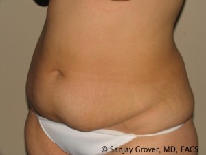 Tummy Tuck Before and After 79 | Sanjay Grover MD FACS