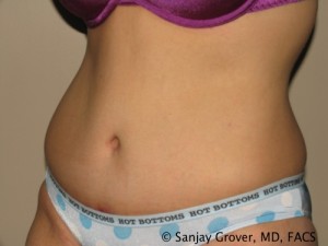 Tummy Tuck Before and After 79 | Grover Aesthetics