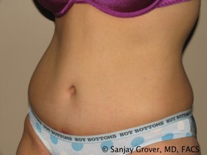 Tummy Tuck Before and After 79 | Sanjay Grover MD FACS