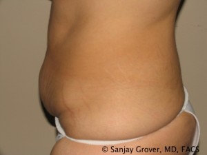 Tummy Tuck Before and After 79 | Sanjay Grover MD FACS