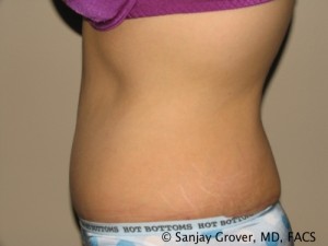 Tummy Tuck Before and After 79 | Sanjay Grover MD FACS