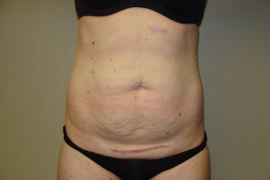 Tummy Tuck Before and After | Grover Aesthetics
