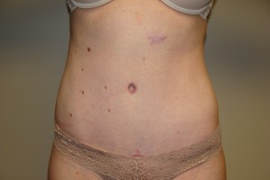 Tummy Tuck Before and After | Grover Aesthetics