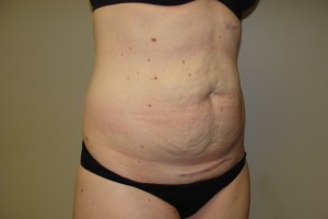 Tummy Tuck Before and After 80 | Grover Aesthetics