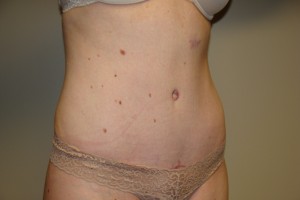 Tummy Tuck Before and After 80 | Grover Aesthetics