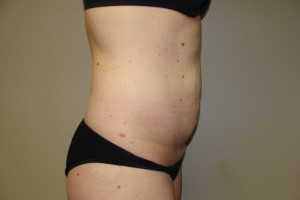 Tummy Tuck Before and After 80 | Grover Aesthetics