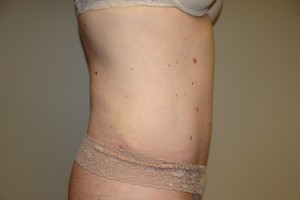 Tummy Tuck Before and After 80 | Grover Aesthetics