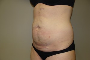 Tummy Tuck Before and After 80 | Grover Aesthetics