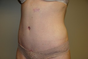 Tummy Tuck Before and After 80 | Grover Aesthetics