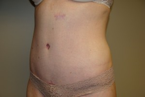 Tummy Tuck Before and After 80 | Sanjay Grover MD FACS