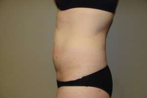 Tummy Tuck Before and After 80 | Grover Aesthetics