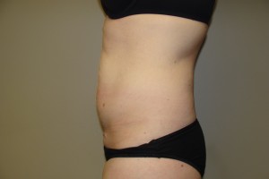 Tummy Tuck Before and After 80 | Sanjay Grover MD FACS