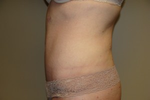 Tummy Tuck Before and After 80 | Grover Aesthetics