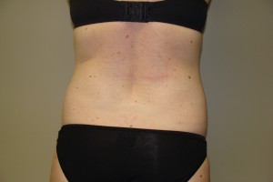 Tummy Tuck Before and After 80 | Grover Aesthetics