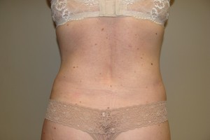 Tummy Tuck Before and After 80 | Grover Aesthetics
