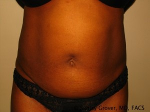 Tummy Tuck Before and After | Grover Aesthetics