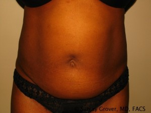 Tummy Tuck Before and After 104 | Sanjay Grover MD FACS