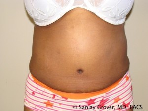 Tummy Tuck Before and After | Grover Aesthetics
