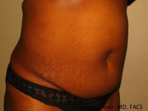 Tummy Tuck Before and After 81 | Grover Aesthetics
